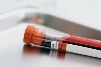 Onlangs werd een bloedtest aangekondigd voor het voorspellen van een verhoogd zelfmoordrisico, maar kunnen we het zelfmoordrisico echt voorspellen met een eenvoudige bloedtest?
