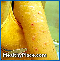 Effecten van dwangmatig plukken van de huid en hoe een huidpluk kan leiden tot littekens en infecties. Bevat complicaties van chronisch huidplukken.